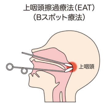 上咽頭擦過療法